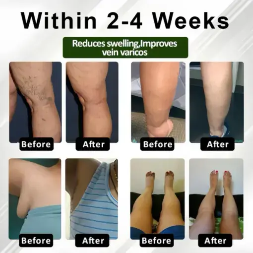 ROSOPL™ Leg Therapy Edema Cream Trust