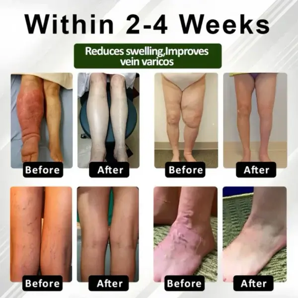 ROSOPL™ Leg Therapy Edema Cream