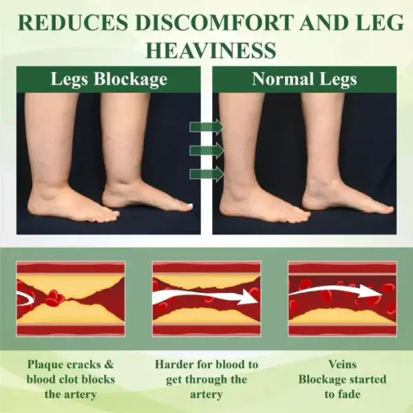 ROSOPL™ Leg Therapy Edema Cream